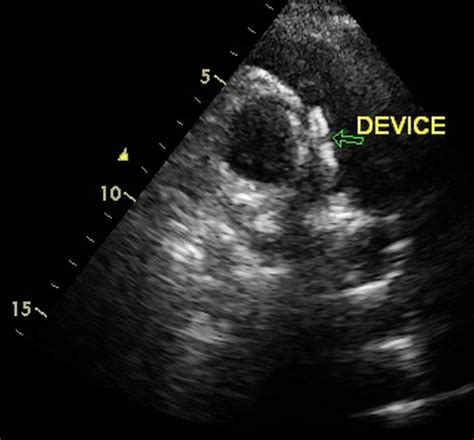 ap window echocardiogram.